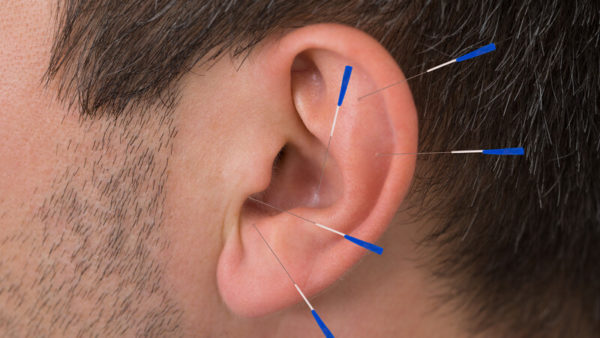 ear acupuncture help with chronic neck pain