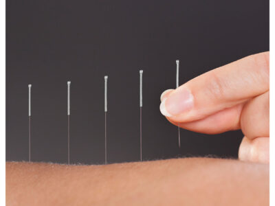 Acupuncture for chronic neck pain